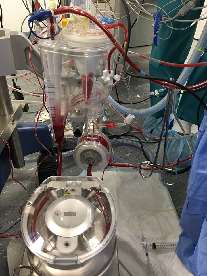 The cardiopulmonary bypass machine (CPB). The oxygenator above replaces the lung function and the main pump below replaces the heart function.