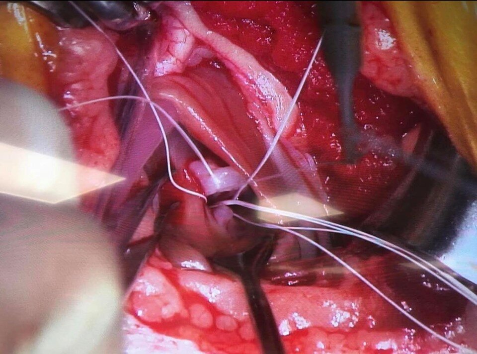 Example pre-placement of artificial cordage’s